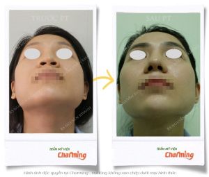 Hình ảnh nâng mũi cấu trúc và cắt cánh mũi sau 3 tuần - Ca 28