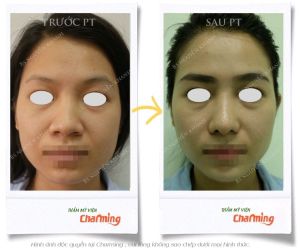 Hình ảnh nâng mũi cấu trúc và cắt cánh mũi sau 3 tuần - Ca 28