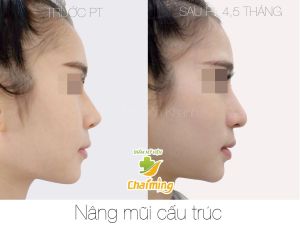 Hình ảnh nâng mũi cấu trúc Bs Nguyễn Khanh - Ca 29