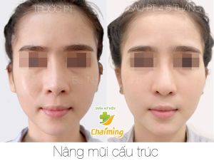 Hình ảnh nâng mũi cấu trúc Bs Nguyễn Khanh - Ca 29