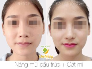 Hình ảnh nâng mũi cấu trúc Bs Nguyễn Khanh - Ca 30