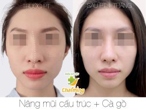 Hình ảnh nâng mũi cấu trúc kết hợp cà gồ Bs Nguyễn Khanh - Ca 31