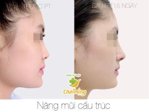 Hình ảnh nâng mũi cấu trúc Bs Nguyễn Khanh - Ca 32