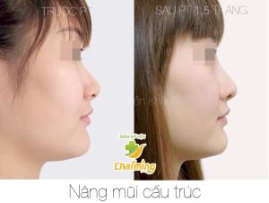 Hình ảnh nâng mũi cấu trúc Bs Nguyễn Khanh - Ca 33