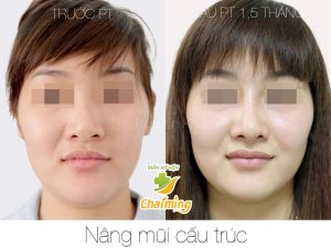 Hình ảnh nâng mũi cấu trúc Bs Nguyễn Khanh - Ca 33