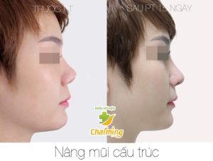 Hình ảnh nâng mũi cấu trúc Bs Nguyễn Khanh - Ca 34