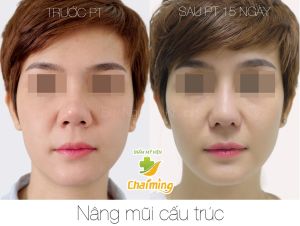 Hình ảnh nâng mũi cấu trúc Bs Nguyễn Khanh - Ca 34