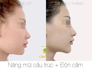 Hình ảnh nâng mũi cấu trúc Bs Nguyễn Khanh - Ca 35