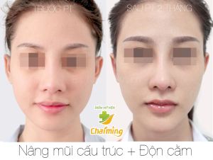 Hình ảnh nâng mũi cấu trúc Bs Nguyễn Khanh - Ca 35
