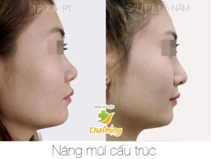 Hình ảnh nâng mũi cấu trúc Bs Nguyễn Khanh - Ca 36