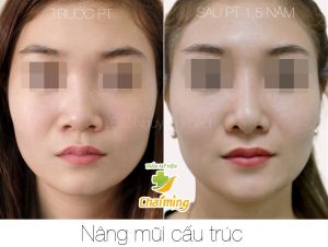 Hình ảnh nâng mũi cấu trúc Bs Nguyễn Khanh - Ca 36