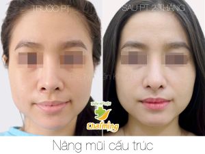 Hình ảnh nâng mũi cấu trúc Bs Nguyễn Khanh - Ca 37