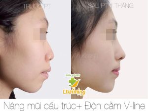 Hình ảnh nâng mũi cấu trúc Bs Nguyễn Khanh - Ca 38