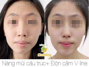 Hình ảnh nâng mũi cấu trúc Bs Nguyễn Khanh - Ca 38