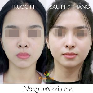 Hình ảnh nâng mũi cấu trúc Bs Nguyễn Khanh - Ca 39