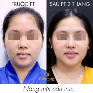 Hình ảnh nâng mũi cấu trúc Bs Nguyễn Khanh - Ca 40