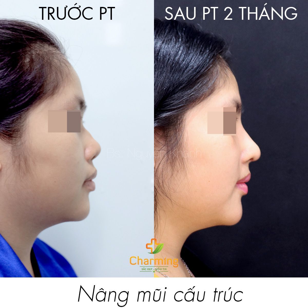 Hình ảnh nâng mũi cấu trúc Bs Nguyễn Khanh - Ca 40