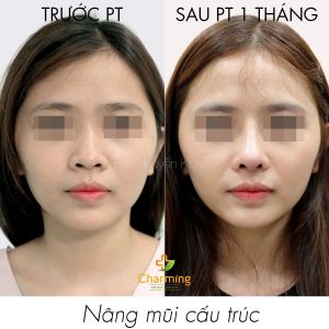 Hình ảnh nâng mũi cấu trúc Bs Nguyễn Khanh - Ca 41