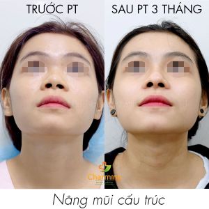 Hình ảnh nâng mũi cấu trúc Bs Nguyễn Khanh - Ca 42