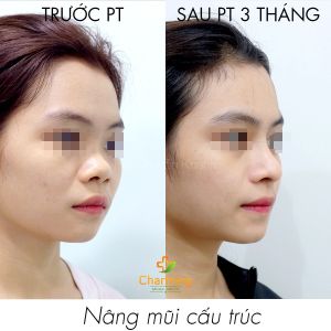 Hình ảnh nâng mũi cấu trúc Bs Nguyễn Khanh - Ca 42