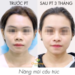 Hình ảnh nâng mũi cấu trúc Bs Nguyễn Khanh - Ca 42
