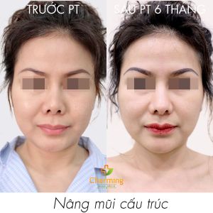 Hình ảnh nâng mũi cấu trúc trước sau 6 tháng Bs Nguyễn Khanh
