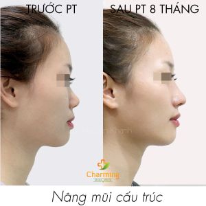 Hình ảnh nâng mũi cấu trúc trước sau 8 tháng Bs Nguyễn Khanh