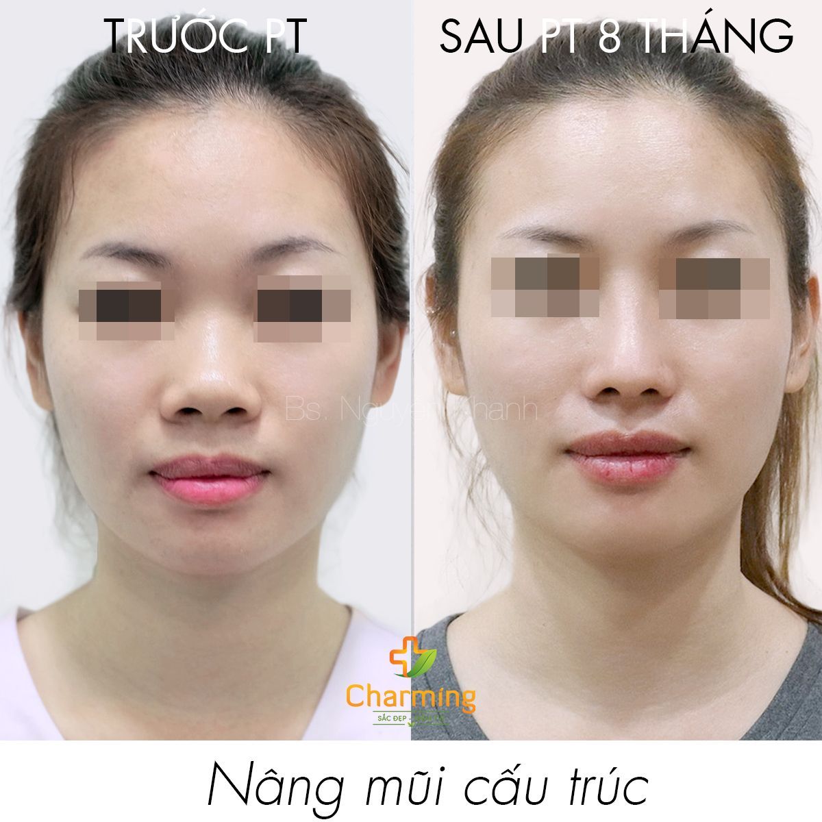 Hình ảnh nâng mũi cấu trúc trước sau 8 tháng Bs Nguyễn Khanh