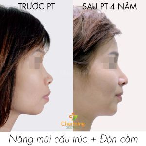 Hình ảnh nâng mũi cấu trúc trước sau 4 năm Bs Nguyễn Khanh