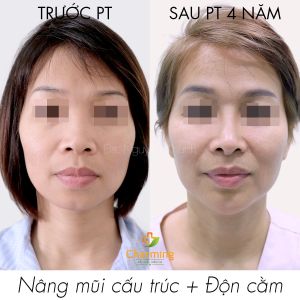 Hình ảnh nâng mũi cấu trúc trước sau 4 năm Bs Nguyễn Khanh