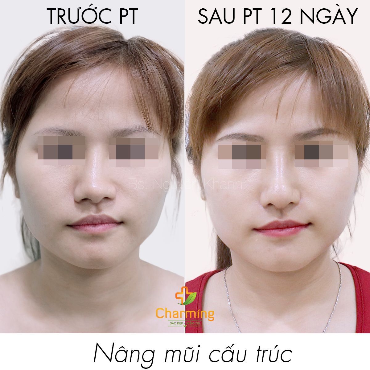 Hình ảnh nâng mũi cấu trúc Bs Nguyễn Khanh - Ca 46