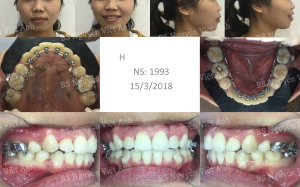 Hình ảnh niềng răng mặt trong làm thay đổi khuôn mặt ở một ca hô xương BS Việt Anh - ca 1