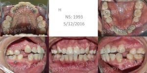 Hình ảnh niềng răng mặt trong làm thay đổi khuôn mặt ở một ca hô xương BS Việt Anh - ca 1
