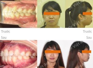 Hình ảnh niềng răng mặt trong làm thay đổi khuôn mặt ở một ca hô xương BS Việt Anh - ca 1