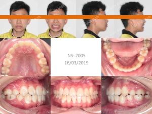 Hình ảnh niềng răng thành công một hàm răng siêu khấp khểnh lộn xộn - Ca 10