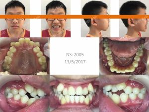 Hình ảnh niềng răng thành công một hàm răng siêu khấp khểnh lộn xộn - Ca 10