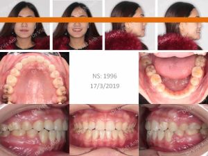 Hình ảnh góc nghiêng đẹp nhờ niềng răng hô, kéo răng khôn mọc ngang thay thế răng số 7 - Ca 11