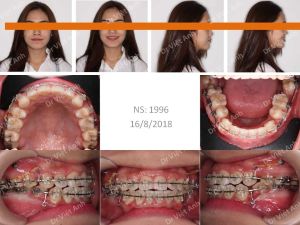 Hình ảnh góc nghiêng đẹp nhờ niềng răng hô, kéo răng khôn mọc ngang thay thế răng số 7 - Ca 11