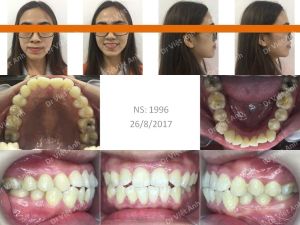 Hình ảnh góc nghiêng đẹp nhờ niềng răng hô, kéo răng khôn mọc ngang thay thế răng số 7 - Ca 11