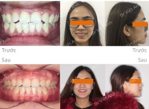 Hình ảnh góc nghiêng đẹp nhờ niềng răng hô, kéo răng khôn mọc ngang thay thế răng số 7 - Ca 11