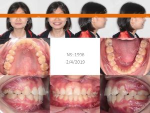 Hình ảnh niềng thành công ca răng chìa như mái hiên sau 20 tháng - Ca 12