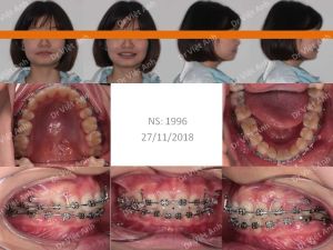 Hình ảnh niềng thành công ca răng chìa như mái hiên sau 20 tháng - Ca 12