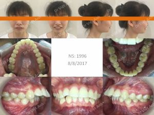 Hình ảnh niềng thành công ca răng chìa như mái hiên sau 20 tháng - Ca 12