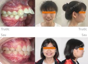 Hình ảnh niềng thành công ca răng chìa như mái hiên sau 20 tháng - Ca 12