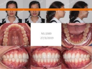 Hình ảnh chỉnh nha mặt lưỡi tối thiểu chữa tình trạng cắn ngược một răng Bs Việt Anh - Ca 3