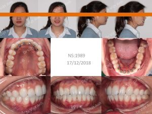 Hình ảnh chỉnh nha mặt lưỡi tối thiểu chữa tình trạng cắn ngược một răng Bs Việt Anh - Ca 3