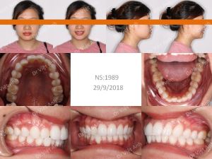 Hình ảnh chỉnh nha mặt lưỡi tối thiểu chữa tình trạng cắn ngược một răng Bs Việt Anh - Ca 3