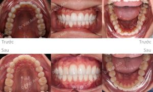 Hình ảnh chỉnh nha mặt lưỡi tối thiểu chữa tình trạng cắn ngược một răng Bs Việt Anh - Ca 3