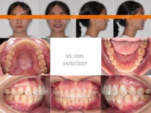 Hình ảnh niềng răng khấp khểnh nặng không nhổ răng bằng phương pháp di xa răng hàm Bs Việt Anh - Ca 4
