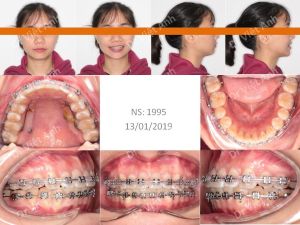 Hình ảnh niềng răng khấp khểnh nặng không nhổ răng bằng phương pháp di xa răng hàm Bs Việt Anh - Ca 4